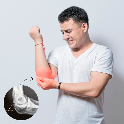 Person holding their elbow in pain due to sudden locking and restricted movement caused by loose bodies in the joint.